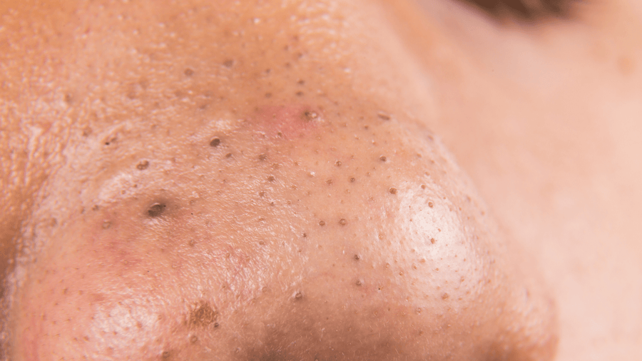 How to Remove Blackheads Without Damaging Your Skin - GRAES