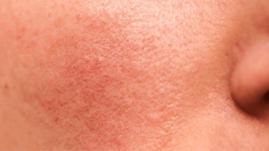 How to Tell If Your Skin Barrier Is Damaged (And What to Do About It) - GRAES