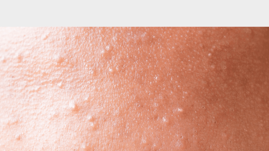 What Causes Clogged Pores and How to Treat Them (Without Overcomplicating Your Routine) - GRAES